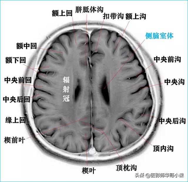 頭顱ct解剖圖,頭部骨骼結構圖(顱腦磁共振mri解剖結構以及高清圖譜)