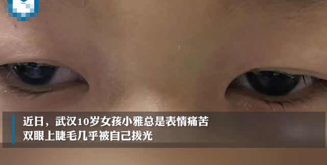 床上螨虫咬的症状图片，如何判断被褥有没有螨虫以及如何预防（医生从9根睫毛找到21条螨虫）