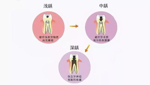 牙髓炎快速止痛，牙髓炎怎么快速止痛（说牙髓炎可以自愈的人给我站出来）