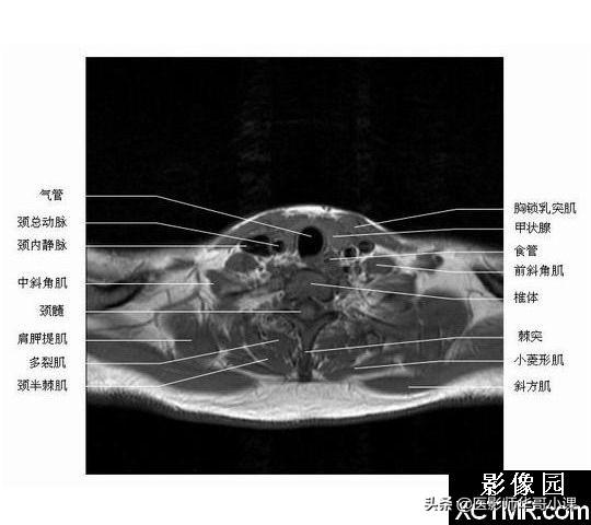 颅脑mri(头部MRI)插图(57)