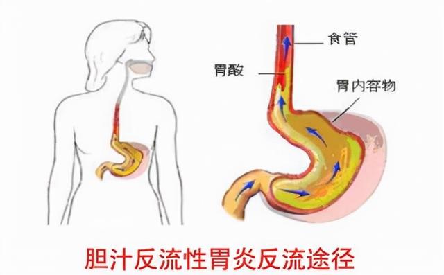 在医学上的解释是由于消化系统功能减弱,肠液和胆汁反流到胃部,导致