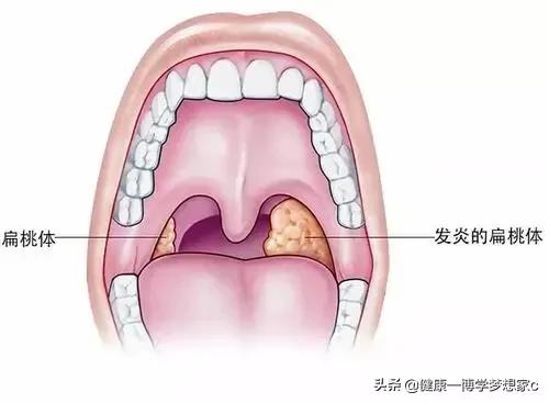 慢性咽炎的症状一般为咽干,咽痛,干咳,咽喉部有异物感等