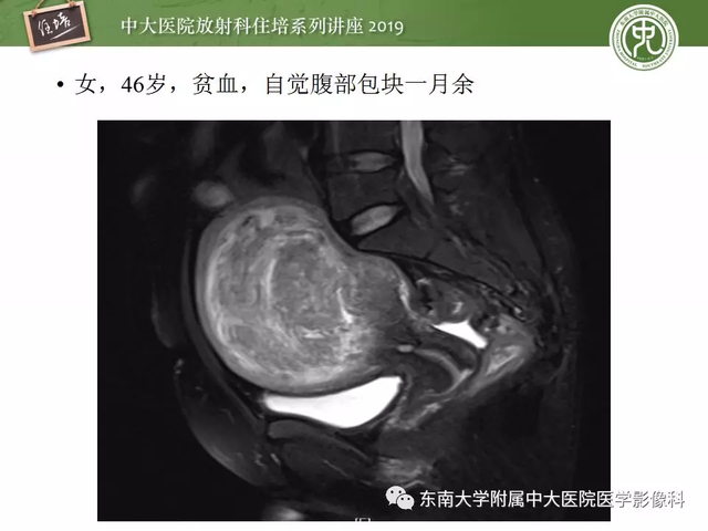 子宫颈影像解剖，子宫详细解剖及磁共振信号分析