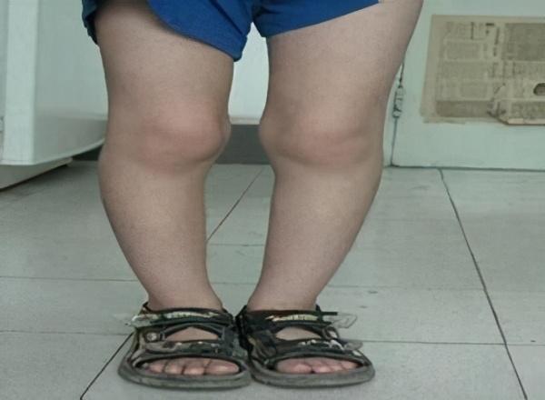 顶骨凸起 面相,佝偻病的症状和临床特点 - 玉三网