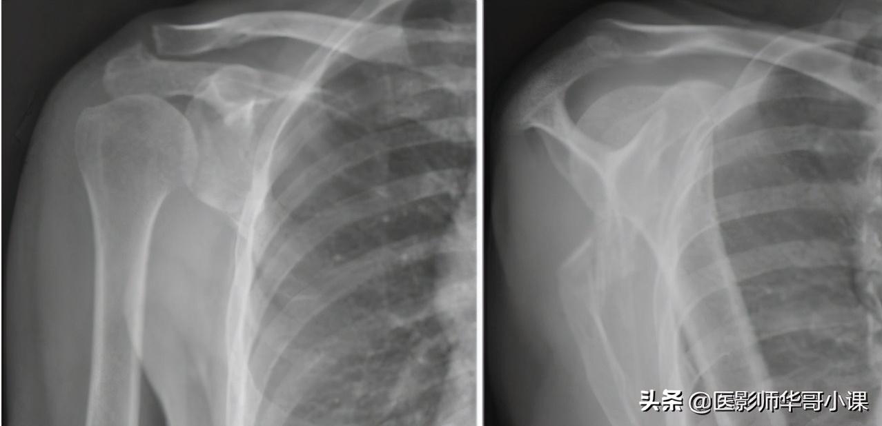 尺骨桡骨怎么区分，怎样分辨尺骨和桡骨（骨关节记忆要点，请收藏）