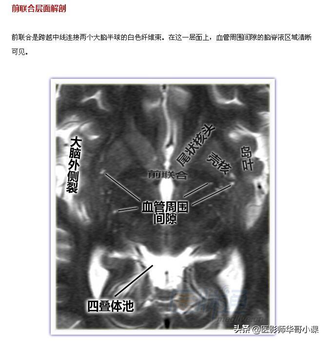 颅脑mri(头部MRI)插图(20)