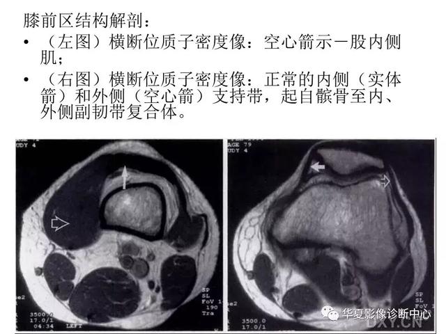 膝关节解剖结构图，膝盖解剖图示意图（膝关节MRI之正常解剖综述）