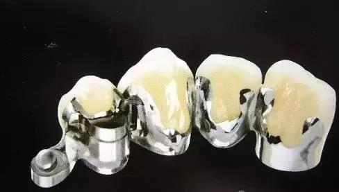 烤瓷牙是怎么做的，烤瓷牙是怎么做的伤牙吗（牙医教你如何选择烤瓷牙的材料）