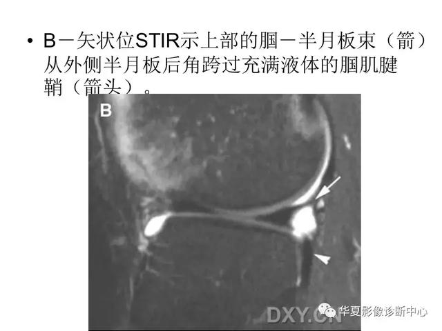 膝关节解剖结构图，膝盖解剖图示意图（膝关节MRI之正常解剖综述）