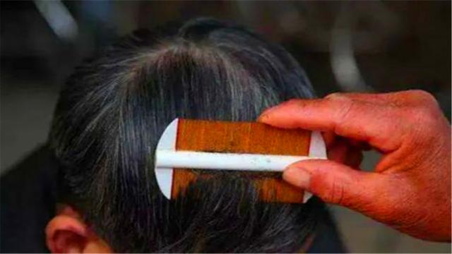 虱子卵长什么样，虱子卵（30年前农村人人都长的虱子）