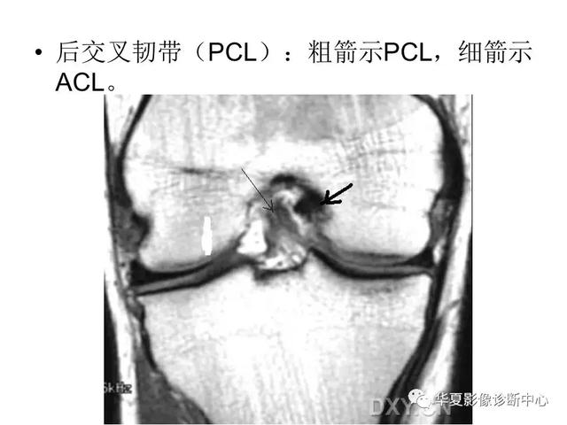 膝关节解剖结构图，膝盖解剖图示意图（膝关节MRI之正常解剖综述）