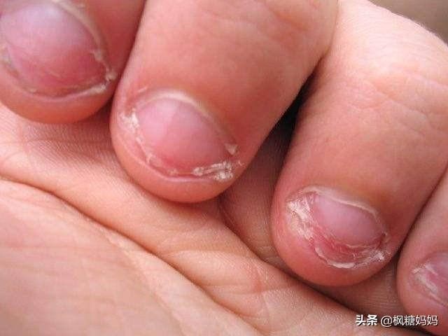 孩子咬指甲缺什么微量元素，孩子经常咬指甲缺什么（并非是缺维生素了）