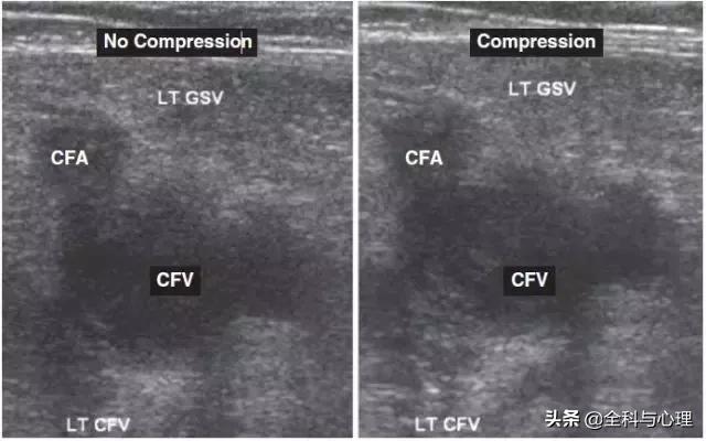 肺栓塞怎么检查，怎么样检查才可以查出肺栓塞（其实 7 个检查就搞定）