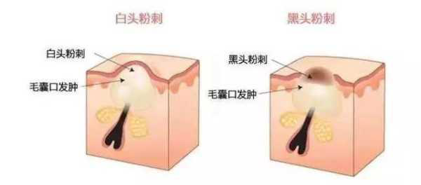 下巴长小痘痘的治疗方法，下巴长痘痘如何治疗（下巴凸起的“小颗粒”和痘痘怎么消除）