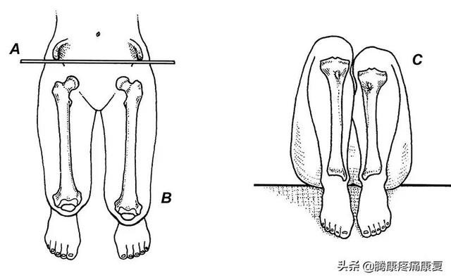 长短腿有什么严重的症状吗，长短腿是怎么产生的