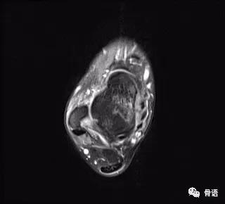 崴脚不拍片怎样判断是否骨折，崴脚怎么判断骨头没事（浅谈“崴脚”你不知道的那点事）