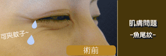 玻尿酸去皱纹好吗，玻尿酸去皱纹多少钱（玻尿酸解决静态皱纹）