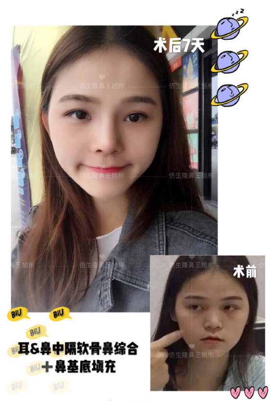 鼻基底填充能改善什么，鼻基底填充好处（鼻基底填充能改善法令纹吗）