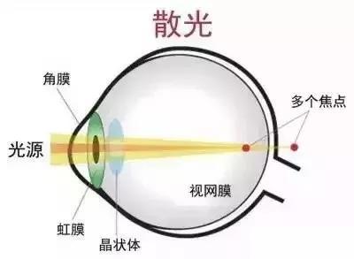 散光多少度正常，散光可以到多少度（“散光”从何而来）