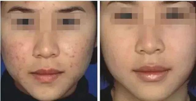 冻干粉用在护肤的哪个步骤，冻干粉免洗面膜效果怎么样（冻干粉是什么，有什么作用）