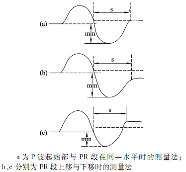 qtc间期正常值，心电图qt和qtc间期正常是多少毫秒