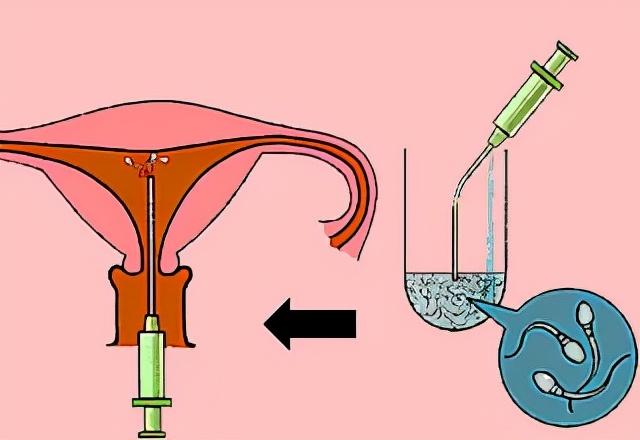深圳在哪捐精可以补贴多少，“我想要个孩子，这样做行不行