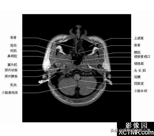 颅脑mri(头部MRI)插图(51)