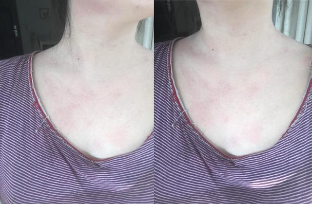 荨麻疹的治疗方法,荨麻疹的治疗方法有哪些(得了荨麻疹怎么办)