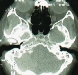 鼻窦炎微创手术，鼻窦炎微创手术价格是多少（诊治及【合理用药）