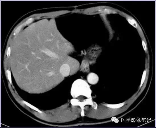 吃赖尿虾的好处，孕妇可以吃濑尿虾吗中期（这8种肝脏变异）