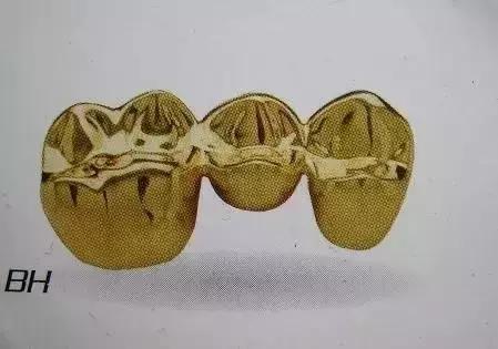 烤瓷牙是怎么做的，烤瓷牙是怎么做的伤牙吗（牙医教你如何选择烤瓷牙的材料）