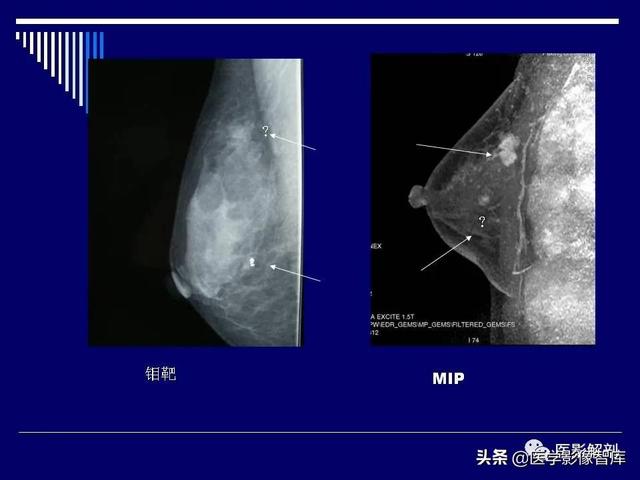 乳房解剖学基础知识，乳腺解剖及乳腺各病变影像诊断与鉴别