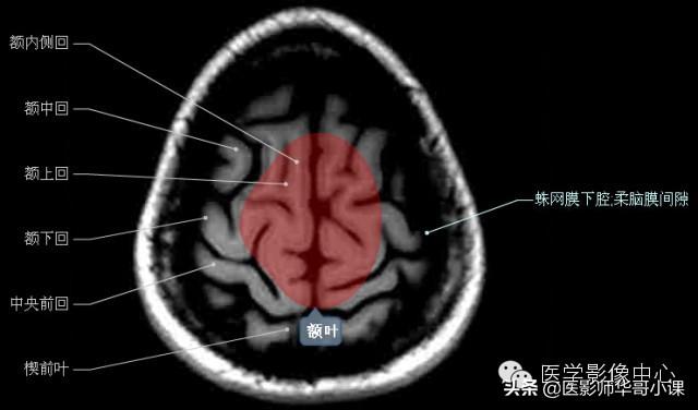 颅脑mri(头部MRI)插图(22)