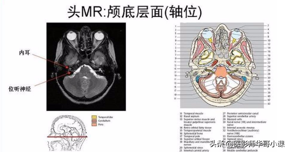 颅脑mri(头部MRI)插图(79)