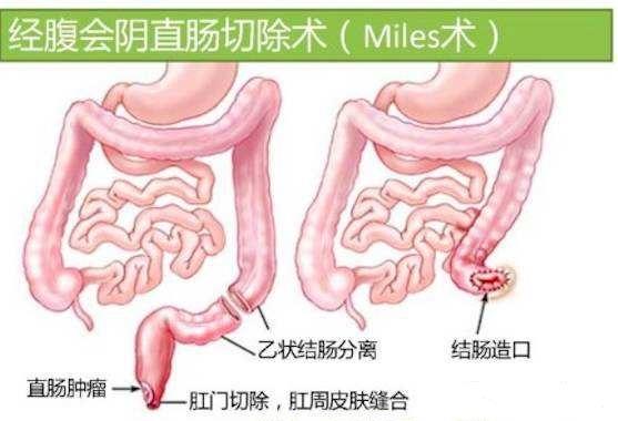 肛门附近长痣代表什么(肛门上长痣代表什么) - 珍缘易学