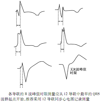 qtc间期正常值，心电图qt和qtc间期正常是多少毫秒