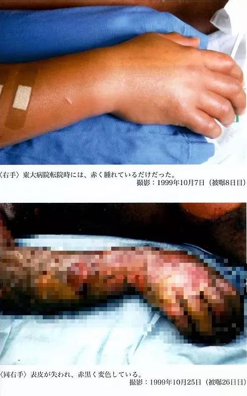 日本东海村核临界事故，日本东海村核临界事故百科（核辐射惨烈堪比十八层地狱）