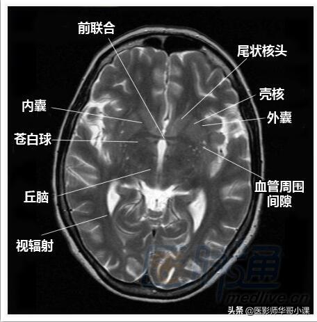 颅脑mri(头部MRI)插图(8)