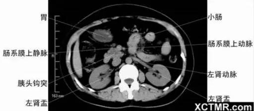 女性腹部解剖结构正面，胸、腹部、盆腔CT解剖
