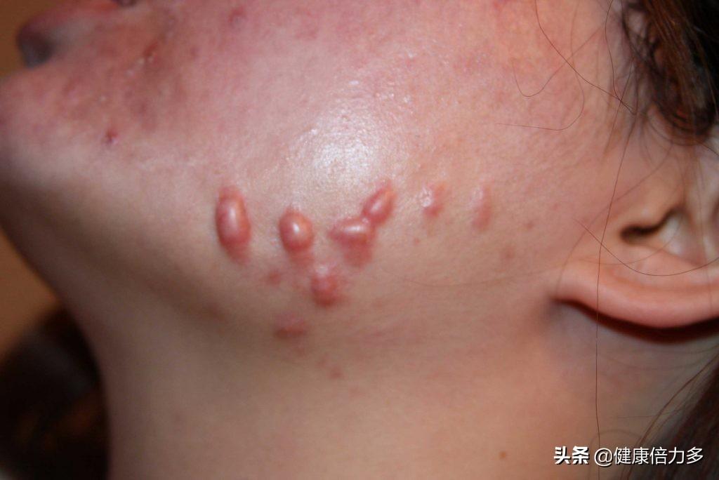 瘢痕一般分为萎缩性瘢痕(凹陷),增生性瘢痕(突出),瘢痕疙瘩(不断增大