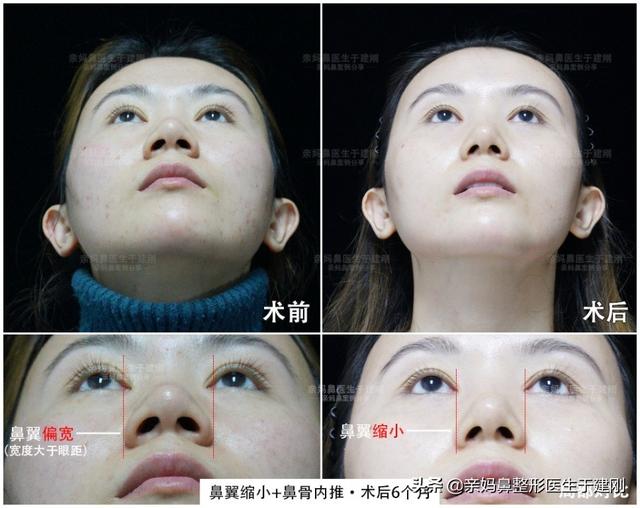 隆鼻后后遗症有哪些呢 隆鼻手术后注意事项，隆鼻后后遗症有哪些呢（我来告诉你隆鼻术后运动的真相）