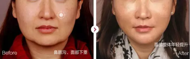 超声波治疗仪的作用与效果，超声波治疗仪应用及功能作用（突然变老的皮肤“超声刀”有效果吗）