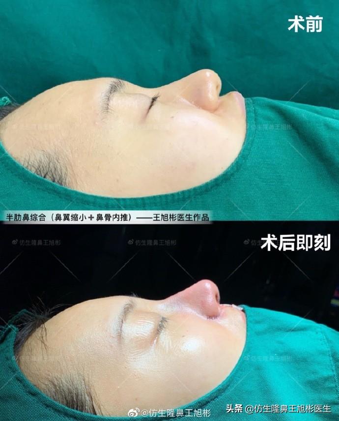 肋骨鼻基底填充好不好_好填充鼻基底肋骨多久恢复_好填充鼻基底肋骨会移位吗