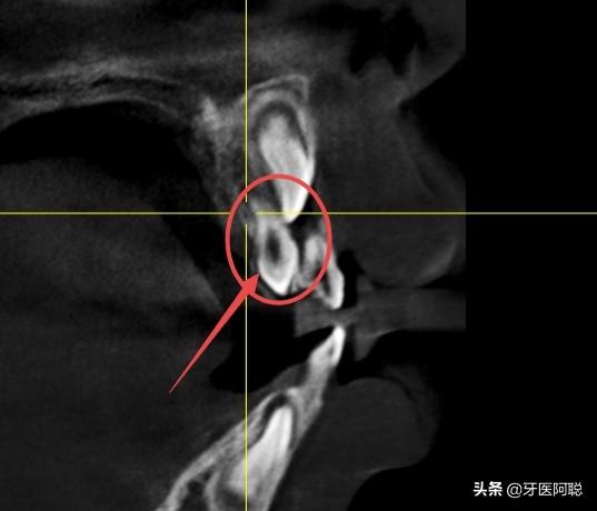 上门牙多生牙图片(多生牙的治疗最佳治疗方法)插图(2)