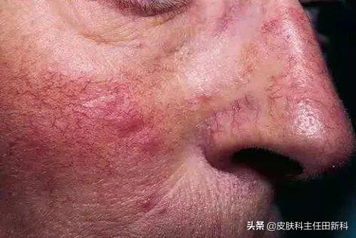手上皮癣早期症状图片，皮癣的真实图片（你脸上成片“痘印”）