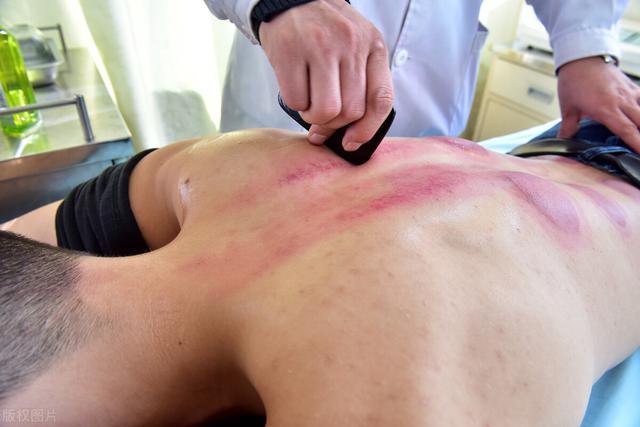 刮痧颜色症状对照表图片，刮痧颜色症状对照表（刮痧之后的“一片红”）