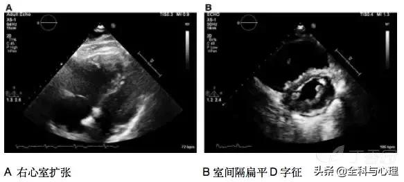 肺栓塞怎么检查，怎么样检查才可以查出肺栓塞（其实 7 个检查就搞定）