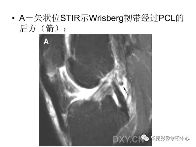 膝关节解剖结构图，膝盖解剖图示意图（膝关节MRI之正常解剖综述）