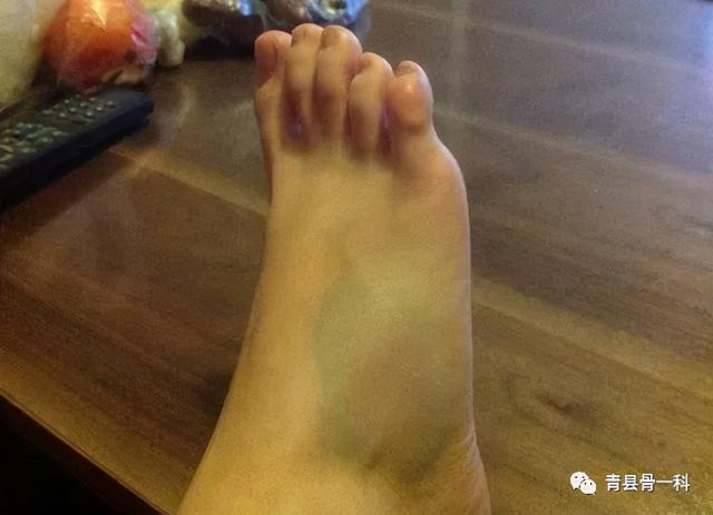 脚扭伤五六年了一走路多就疼，脚崴了七八年了还是疼（脚崴了不肿但走路就疼怎么回事）