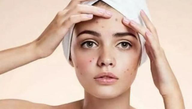 牙膏去痘痘最快的方法，牙膏一夜快速祛痘偏方（你知道牙膏洗脸的功效吗）